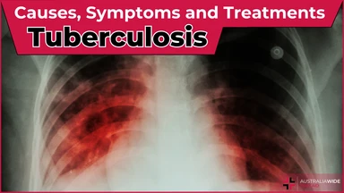 Tuberculosis article header – First Aid Article in Greenwich